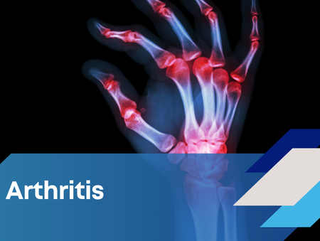 Mark Beasley Arthritis Resources
